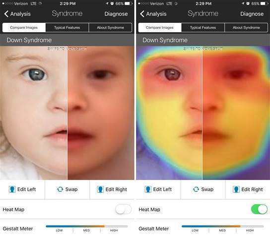 Image: Facial recognition app Face2Gene is being used by doctors to diagnose rare diseases